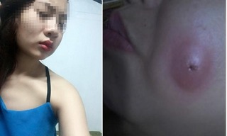 Thiếu nữ bỏ 500.000 làm má lúm tại nhà vì tin quảng cáo trên Facebook và đây là kết quả