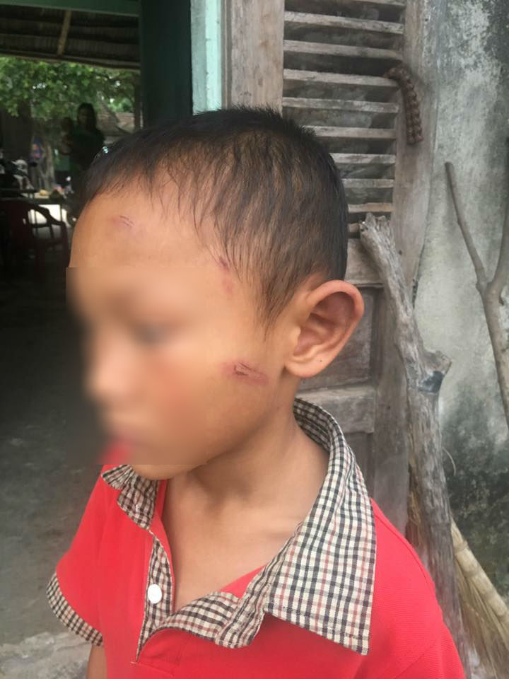 Bé trai ở Quảng Ngãi bị dì ruột bạo hành 3
