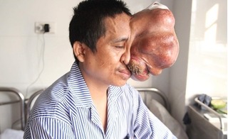 Người đàn ông có khối u trên mặt: 14 năm sống khốn khổ vì một chữ nghèo!