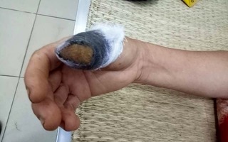 Hai người phụ nữ hỗn chiến đến đứt rời ngón tay chỉ vì... nắm lá mồng tơi