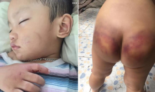 Nghi án người tình của mẹ đánh đập bé trai 2 tuổi: Nựng yêu vào má và bị tụ máu 