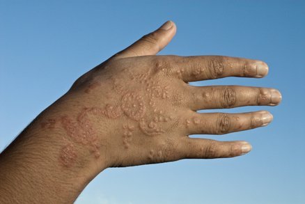 Mực xăm henna để lại sẹo lồi rất nguy hiểm