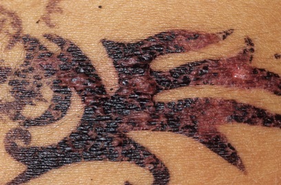 Mực xăm tạm thời, xăm henna đều có nguy cơ gây dị ứng da rất nguy hiểm.