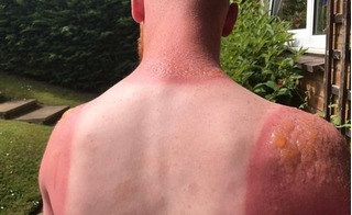 Bạn có biết, bỏng nắng có thể gây nhiễm độc về da?