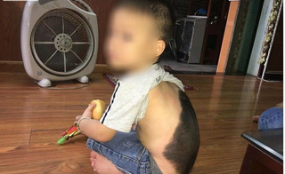Căn bệnh kì lạ khiến bé trai 3 tuổi mọc lông đầy mình như sói