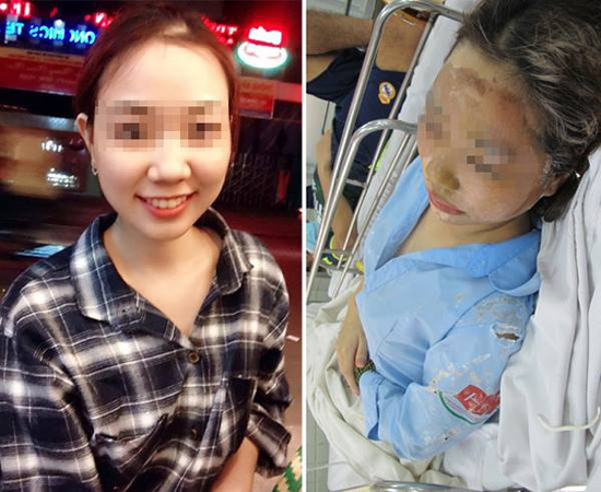 Nữ sinh Thu Hương bị tạt axit