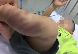 Cháu bé bị nghi bạo hành ở Hà Nội: Cơ quan chức năng ra quyết định khởi tố 