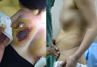Thai phụ tử vong sau nâng ngực: Trước đó có vô vàn ca phẫu thuật bị biến chứng đến mức phải cắt bỏ nhũ hoa 