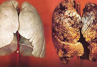 Điểm danh những loại thực phẩm chứa asen có thể gây ung thư phổi