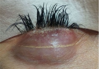 Ham hố nối mi - dính quả đắng vì bầy ký sinh trùng trong mắt