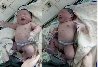 Vĩnh Phúc: Bác sỹ sản khoa sốc khi đỡ đẻ bé trai sơ sinh nặng hơn 7kg 