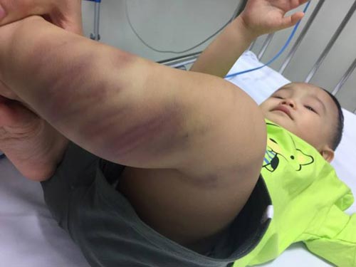 Bé trai bị bạo hành dã man ở Hà Nội sức khỏe có biểu hiện xấu