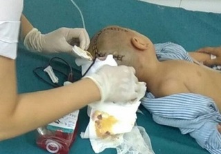 Thái Bình: Bé trai 3 tuổi xuất huyết não phải mổ gấp khi ở trường về