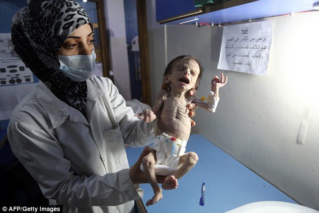  em bé Syria gầy trơ xương