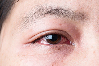 Trị đau mắt đỏ bằng thuốc nam cực hiệu quả 
