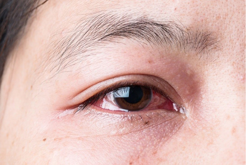 Trị đau mắt đỏ bằng thuốc nam cực nhanh và hiệu quả
