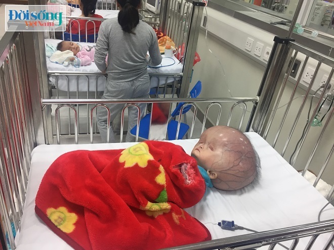 Bé trai mắc bệnh đầu nặng 15kg ở Thanh Hóa