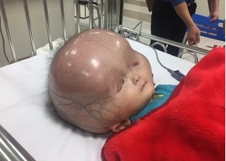 Cháu bé bị não úng thủy ở Thanh Hóa: Bác sĩ Singapore nói có khả năng cứu chữa