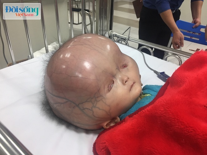 Đầu cháu bé bị não úng thủy ở Thanh Hóa to bất thường