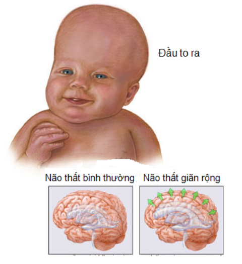 não úng thủy có thể điều trị được nếu can thiệp sớm hình ảnh