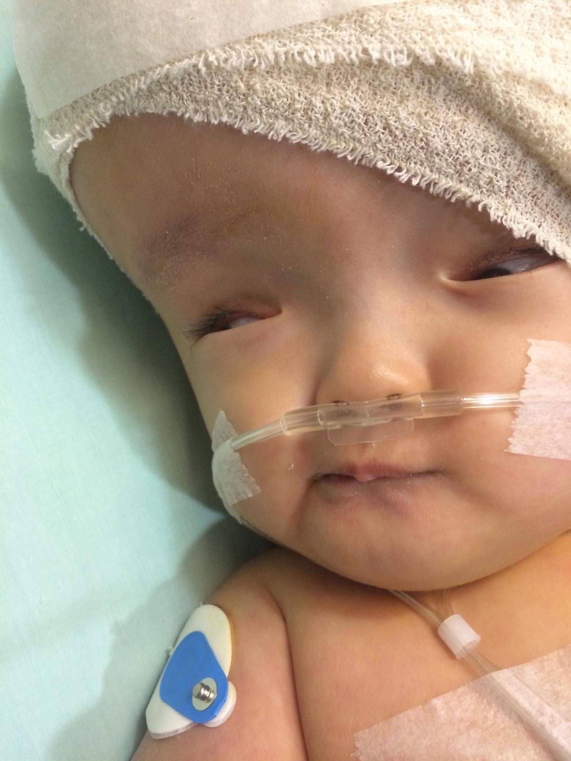 Bé gái 8 tháng tuổi bị não úng thủy sang Singapore đã phẫu thuật