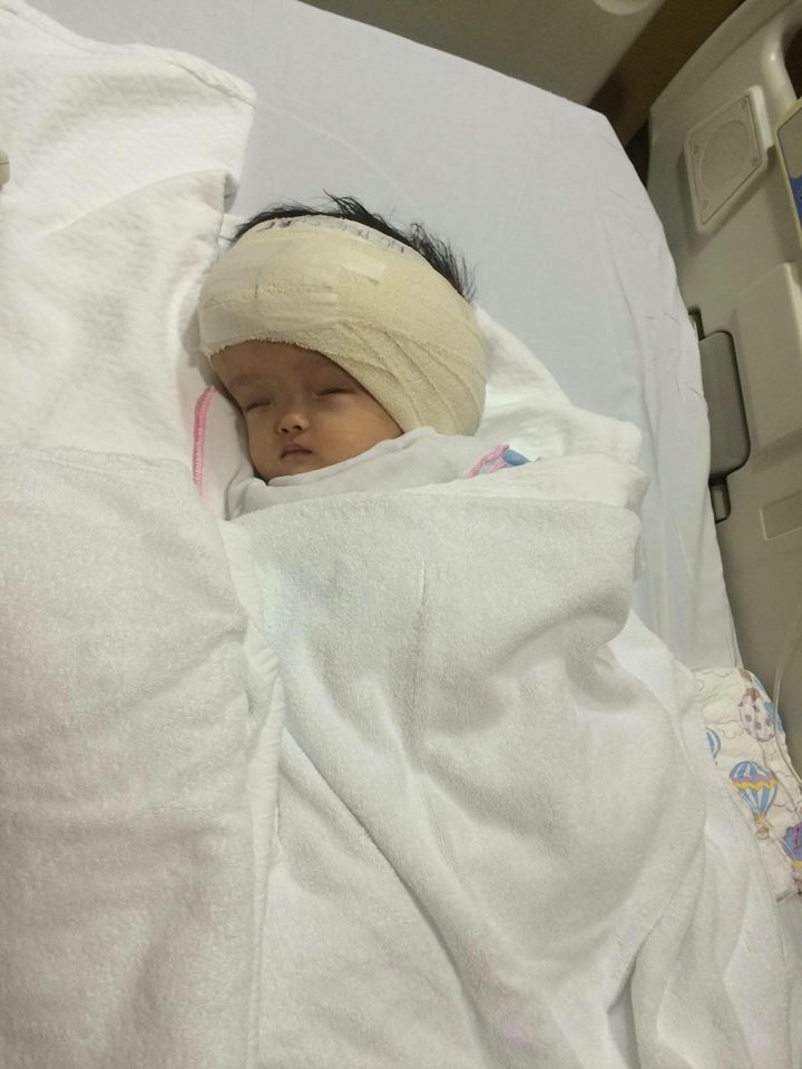 Ca phẫu thuật đặt ống VP Shunt của bé Hoài Thương đã thành công