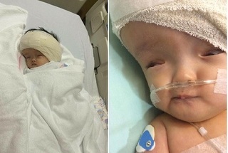 Bé gái 8 tháng tuổi bị não úng thủy sang Singapore phẫu thuật thành công 