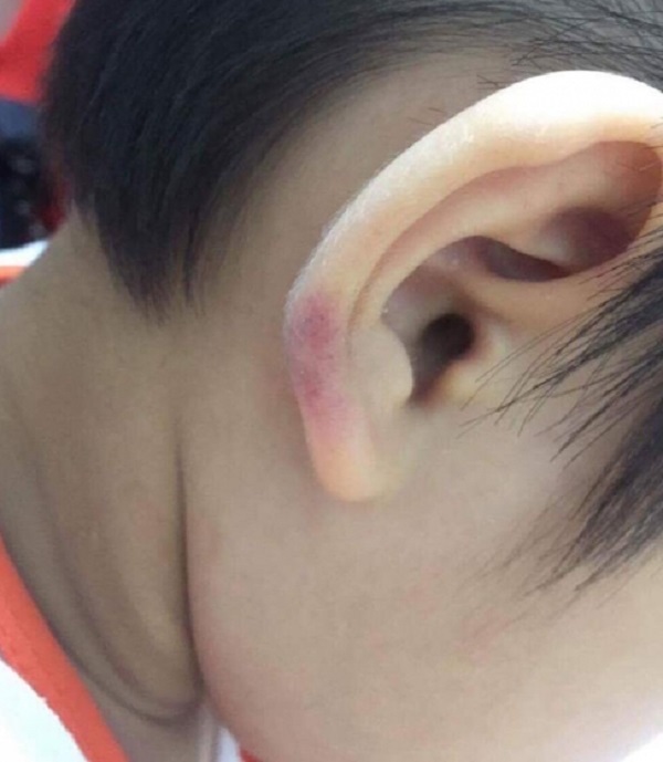 Bé trai bị bạo hành dã man ở Hà Nội