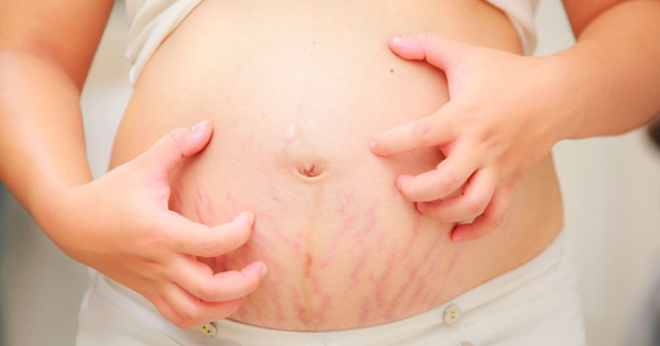 biến đổi khi mang thai mẹ bầu không nên lo lắng rạn da