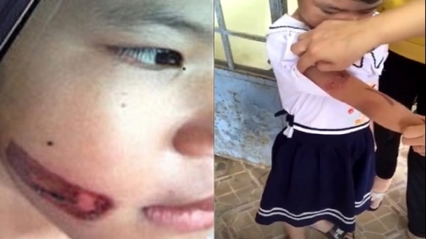 Bé gái bị cha ruột dí thanh sắt nóng vào mặt ở Kiên Giang