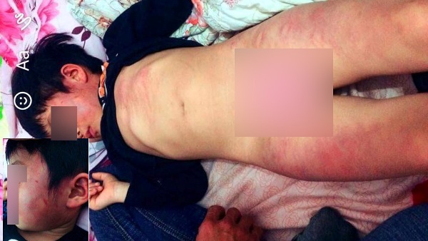 Bắc Giang: Bé trai bị nghi bị cô giáo đánh bầm dập khắp người 