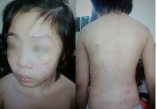 Hà Nội: Bé 10 tuổi nghi bị mẹ kế và bố ruột bạo hành đến gãy xương sườn, rạn sọ não