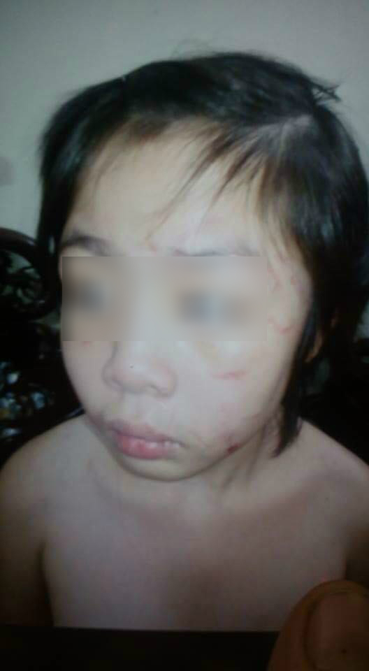 Hà Nội:Bé 10 tuổi nghi bị mẹ kế và bố đẻ bạo hành gãy xương sườn