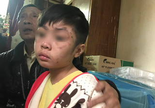Bé trai 10 tuổi bị bố ruột và mẹ kế bạo hành ở Hà Nội: 