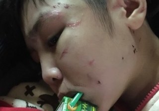 Bé trai bị bố ruột và mẹ kế bạo hành dã man ở Hà Nội: Xương sườn tổn thương 70%