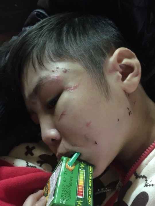 Bé trai bị bố ruột và mẹ kế bạo hành ở Hà Nội bị tổn thương xương sườn đến 70%