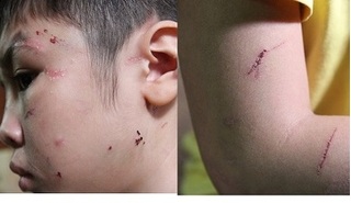Cận cảnh những vết thương trên người bé trai bị bố ruột và mẹ kế bạo hành dã man ở Hà Nội