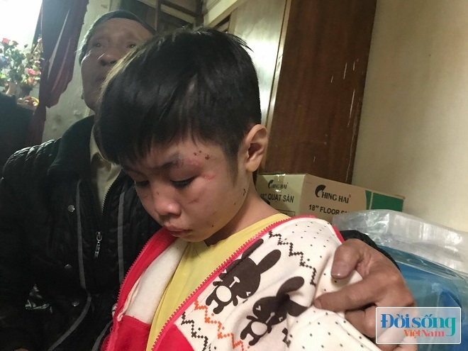 Mẹ kế bạo hành bé trai ở Hà Nội: Cháu không thích học