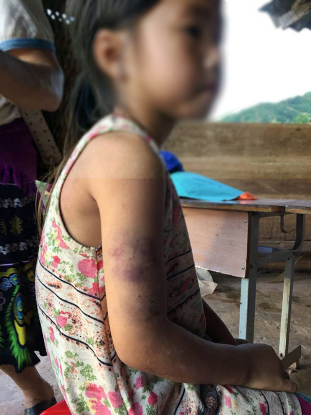 Học sinh lớp 2 bị cô giáo đánh bầm tím cánh tay vì viết chữ xấu