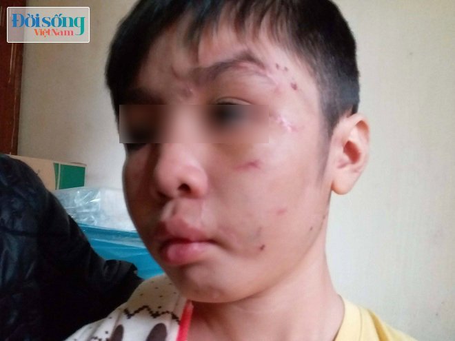 Vụ bé trai 10 tuổi bị bạo hành, yêu cầu phải xử lý nghiêm2