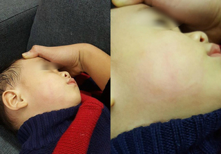 Đi rửa mũi tại phòng khám, bé trai 23 tháng bị bác sĩ tát sưng mặt