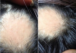Tóc rụng từng mảng trắng cả da đầu vì bỏng hóa chất khi làm đẹp