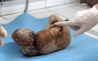 Bào thai hóa đá sau 46 năm nằm trong bụng mẹ