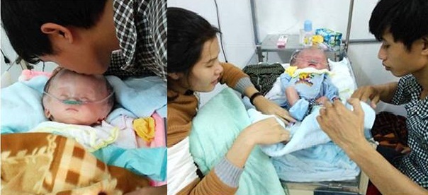 Rơi nước mắt với bé 9 tháng bị não úng thủy đang giành giật sự sống2