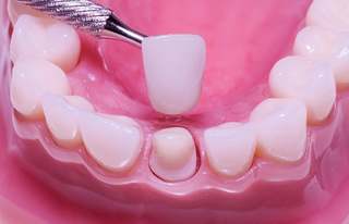 Bảo toàn răng thật 100% với công nghệ phủ răng sứ mới