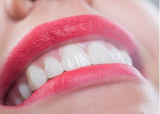 Tìm hiểu công nghệ trám răng thẩm mỹ composite 