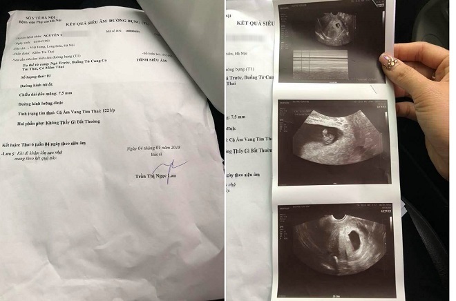 Cô gái sang bệnh viện khác bác sĩ chẩn đoán thai nhi không sao chỉ bị động thai
