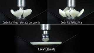Công nghệ bọc răng sứ Lava 3M bền chắc và vô cùng tự nhiên