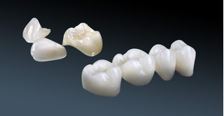 Răng sứ Cercon và công nghệ CAD/CAM tiên tiến nhất