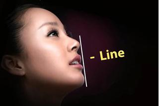 Công nghệ phẫu thuật độn cằm I Line Hàn Quốc tạo nét đẹp thanh tú
